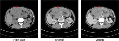 Case report: POLE (P286R) mutation in a case of recurrent intestinal leakage and its treatment